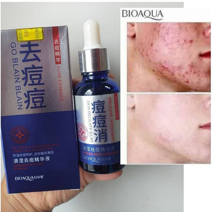 Serum anti acne y control de grasa